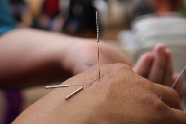 close up on acupuncture treatment on hands for pain relief